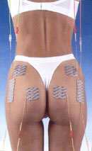 culettocompex